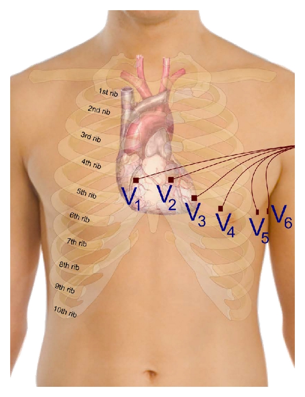 (a) Precordial placement