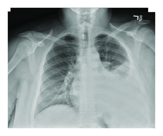 (a) A chest X-ray of the chest showing left side pleural effusion