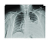 (a) A chest X-ray of the chest showing left side pleural effusion