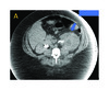(a) A CT scan of the abdomen and pelvis showing a an enlarged left kidney with appearance suggestive of xanthogranulomatous pyelonephritis (arrow)