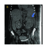(b) A CT scan of the abdomen and pelvis showing a an enlarged left kidney with appearance suggestive of xanthogranulomatous pyelonephritis (arrow)