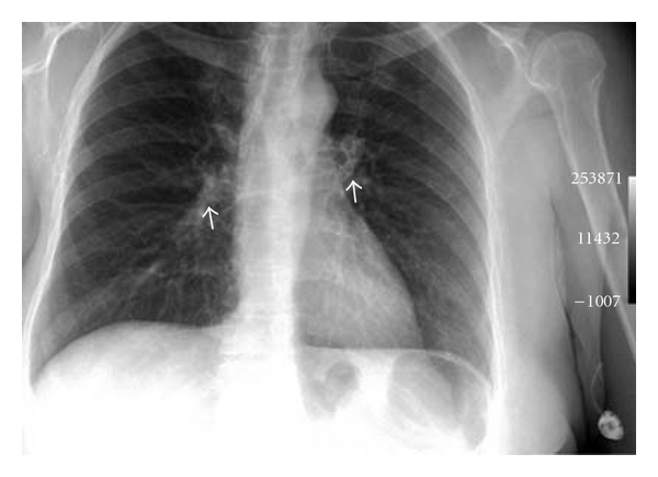 (a) PA Chest X-ray.