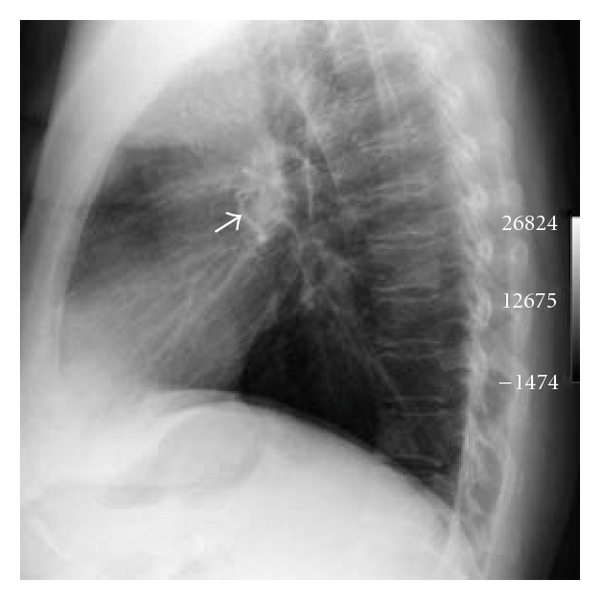 (b) Lateral Chest X-ray.